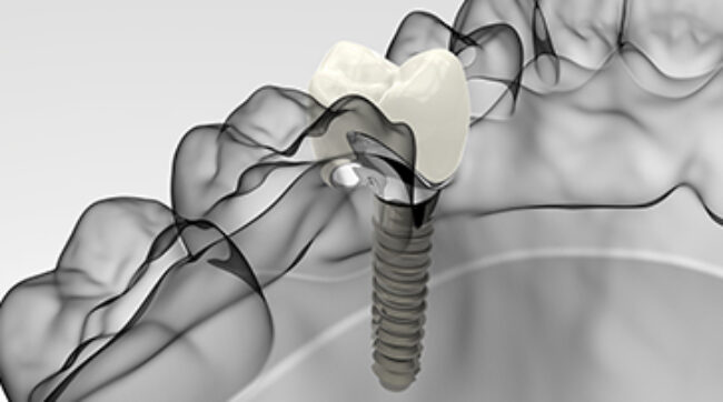 Treatment - Platinum Orthodontics dental