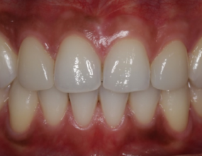 After - Platinum Orthodontics Dental